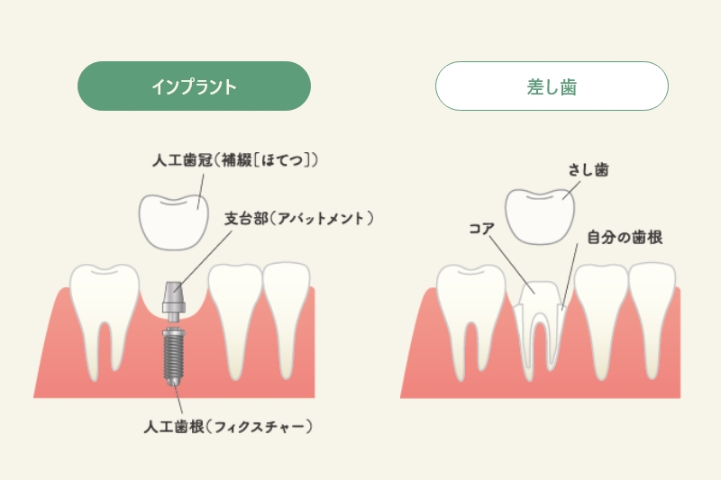 差し歯とインプラントの違い